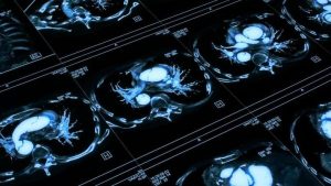 A novel AI-based tool deployed via a federated learning platform to assist in the screening, diagnosis, prevention and therapy evaluation of breast and prostate cancer (CAFEIN2)